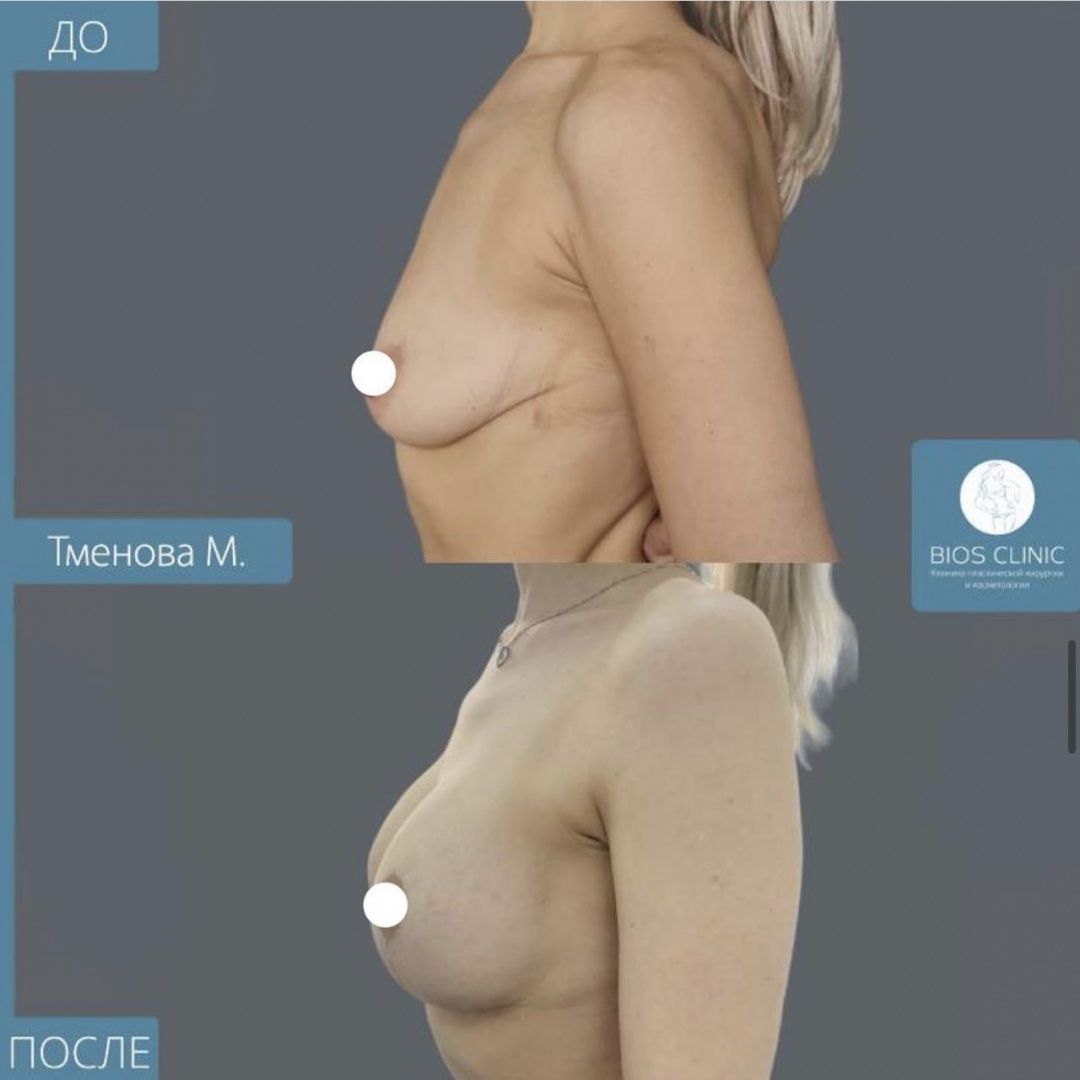 Подтяжка груди Т образная фотография 3