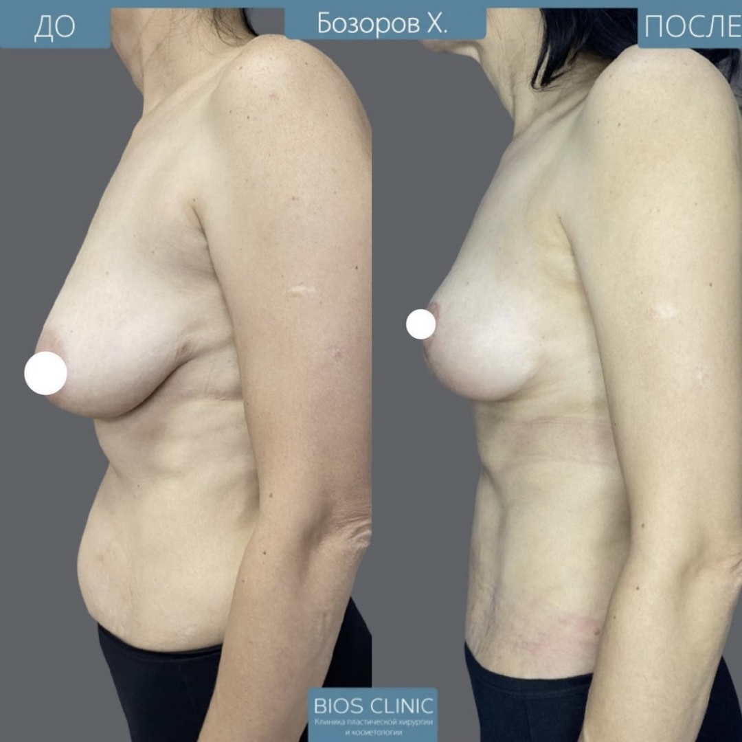 Подтяжка груди с эффектом импланта, абдоминопластика и липосакция боков фотография 3