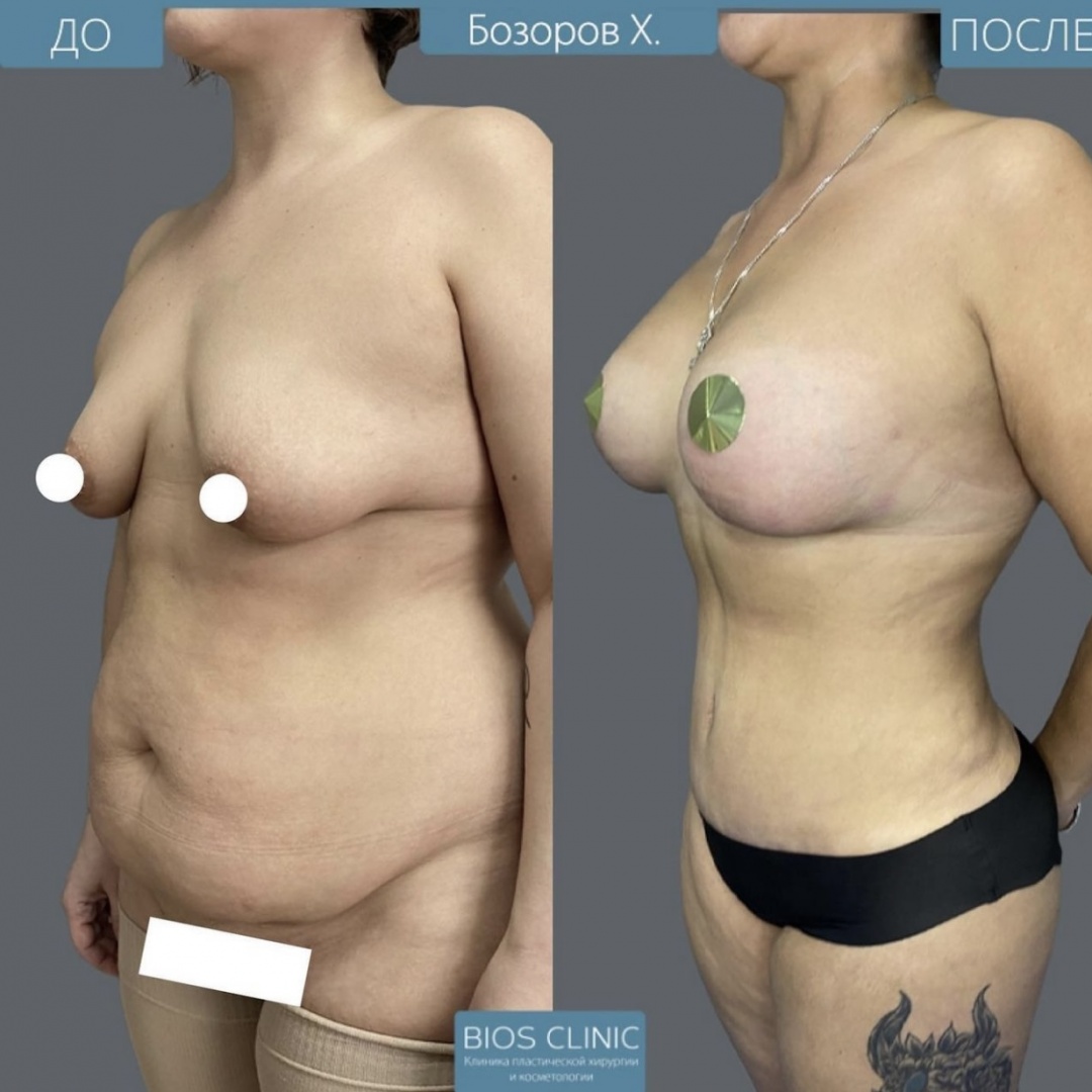 увеличение груди с вертикальной подтяжкой фотография 2