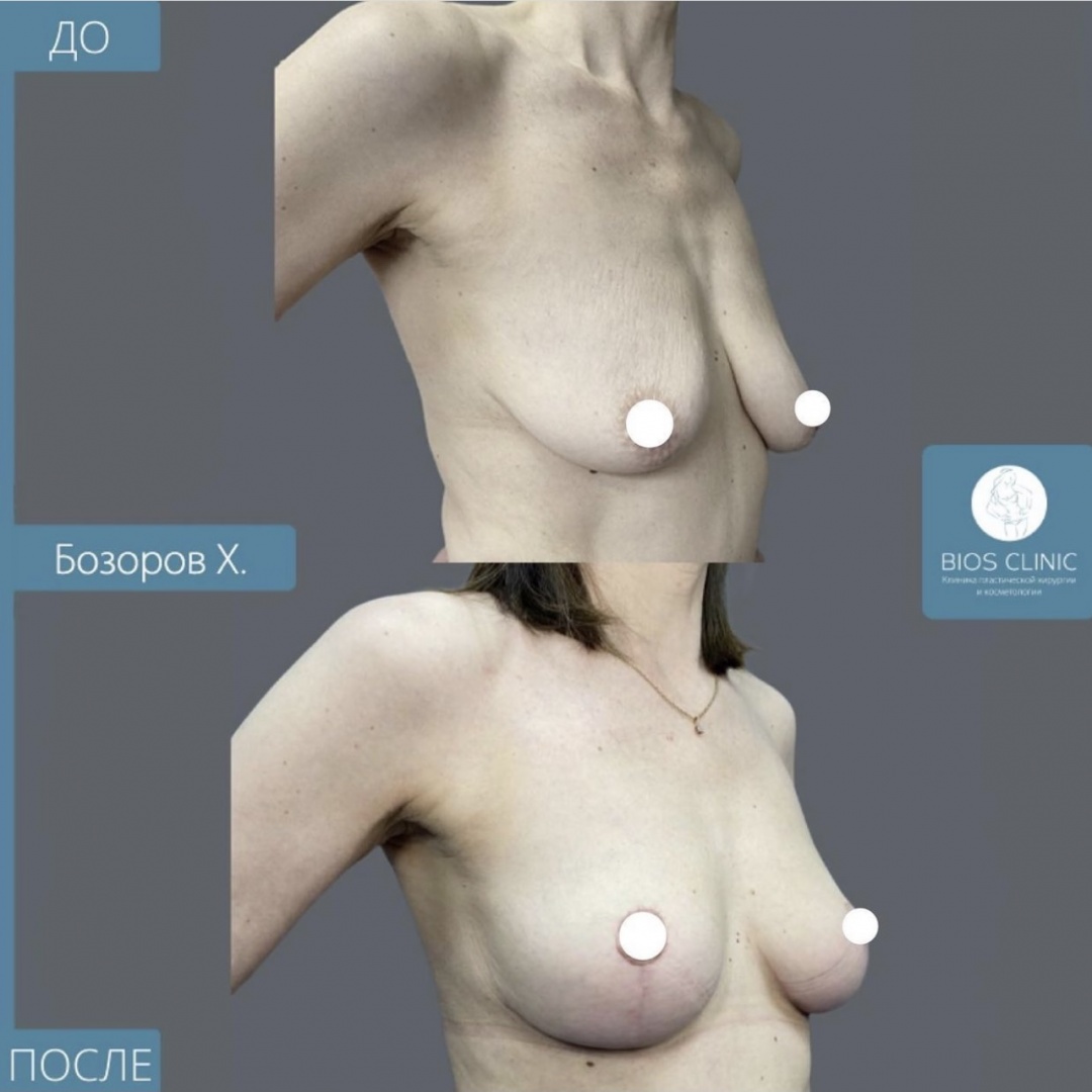 Подтяжки груди без имплантов фотография 2