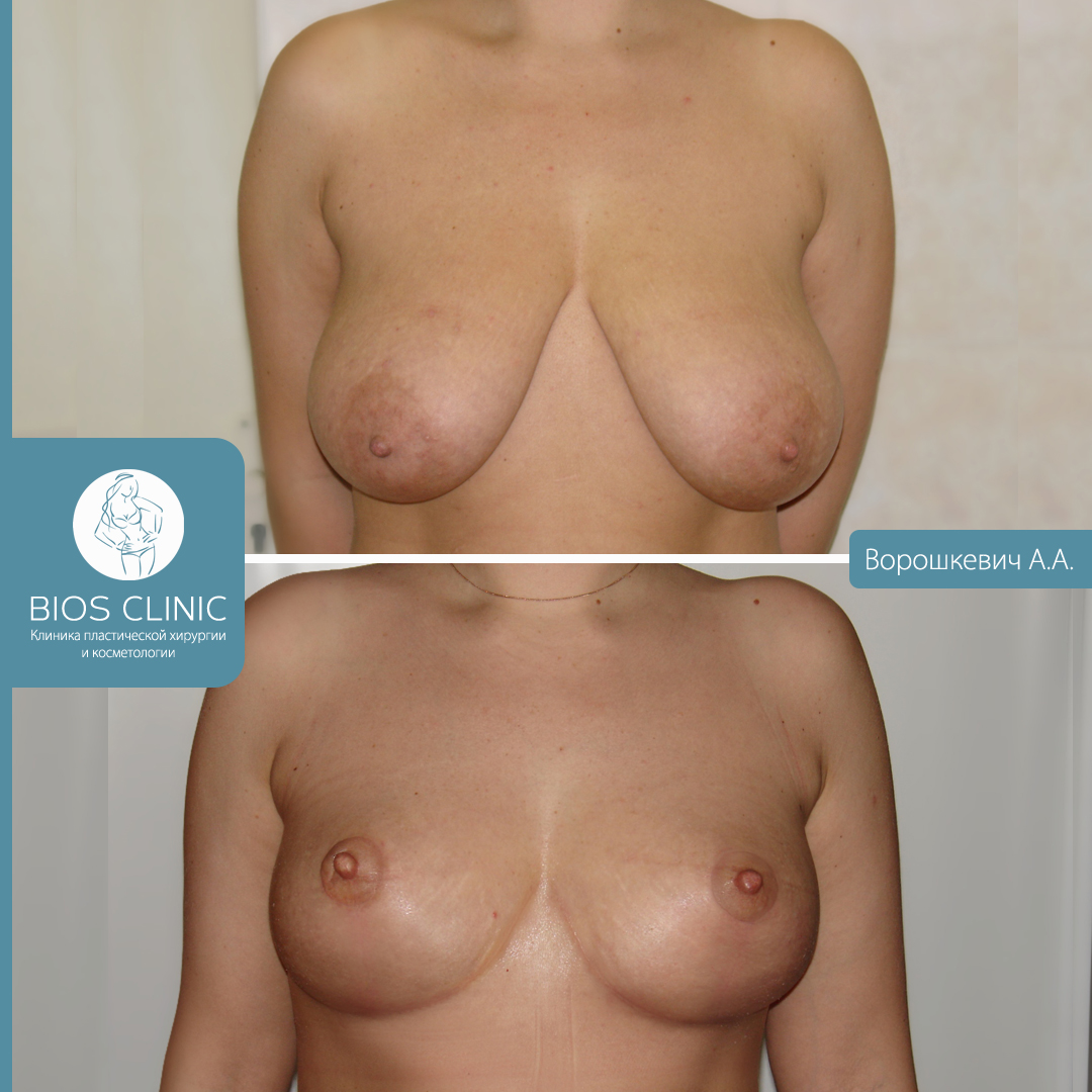 Подтяжка и уменьшение груди фотография 3