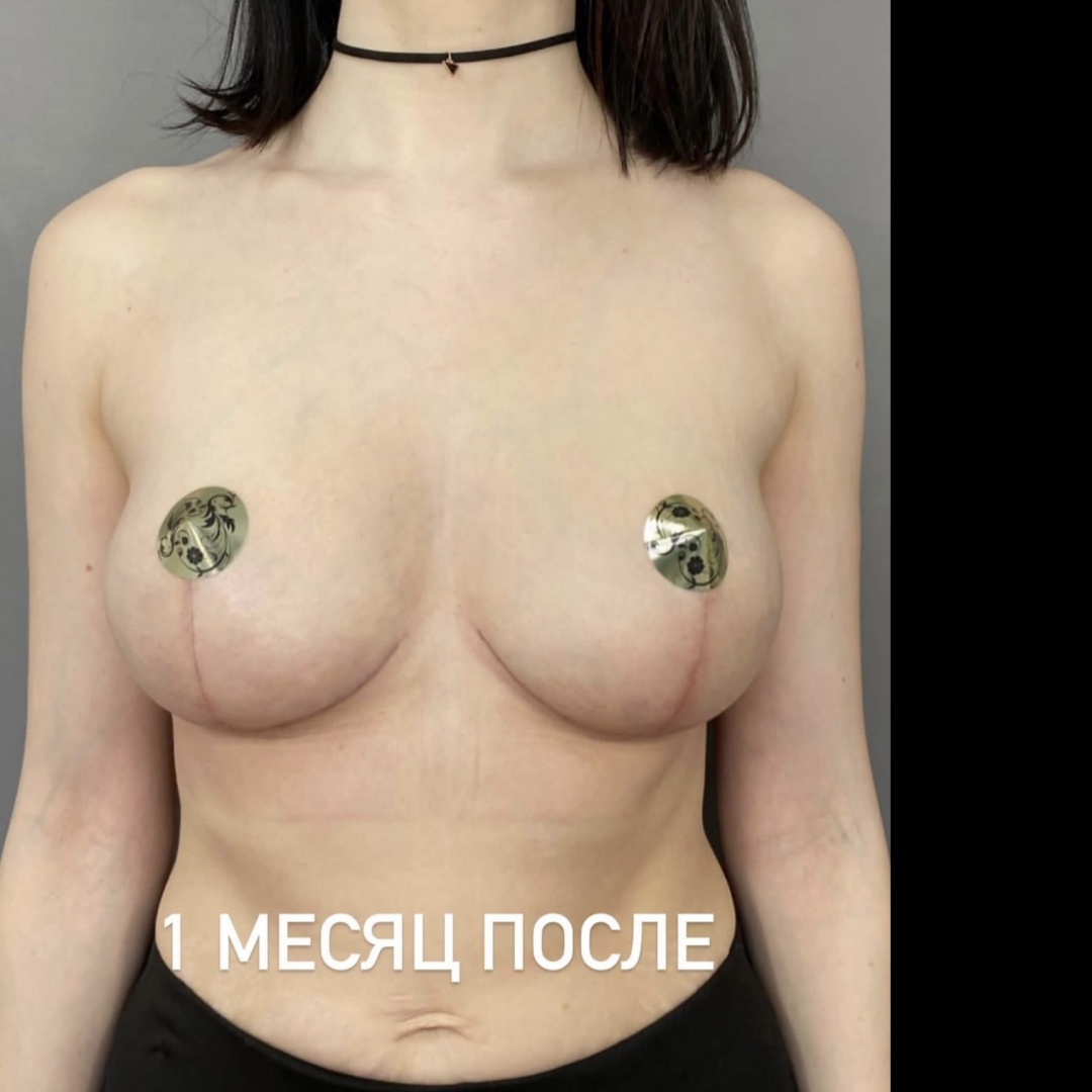 Подтяжка груди с эффектом импланта  фотография 1