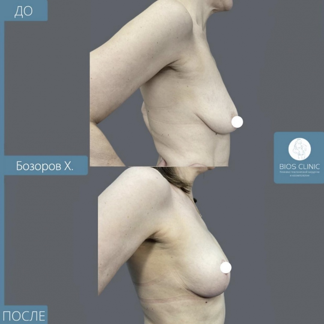 Подтяжки груди без имплантов фотография 1