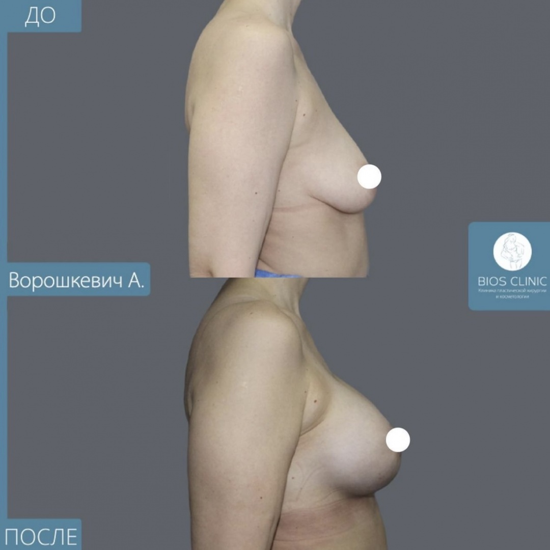Увеличение груди с периареолярной подтяжкой