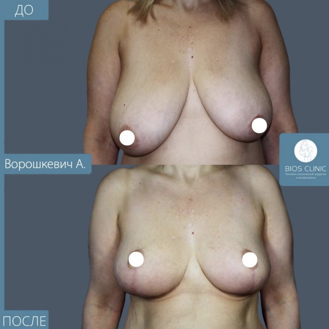 Уменьшение груди фотография 3