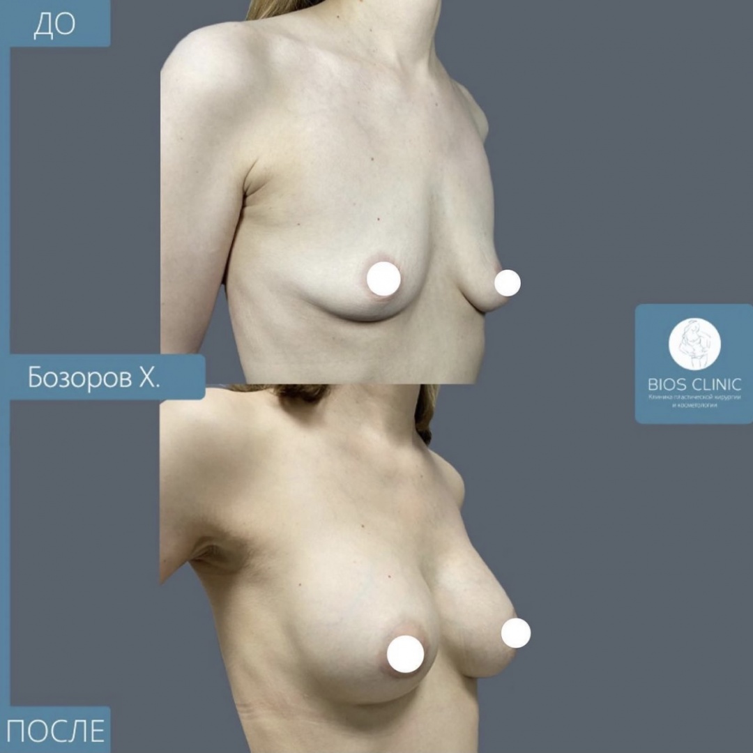 Подтяжка груди с одной стороны для коррекции асимметрии фотография 3