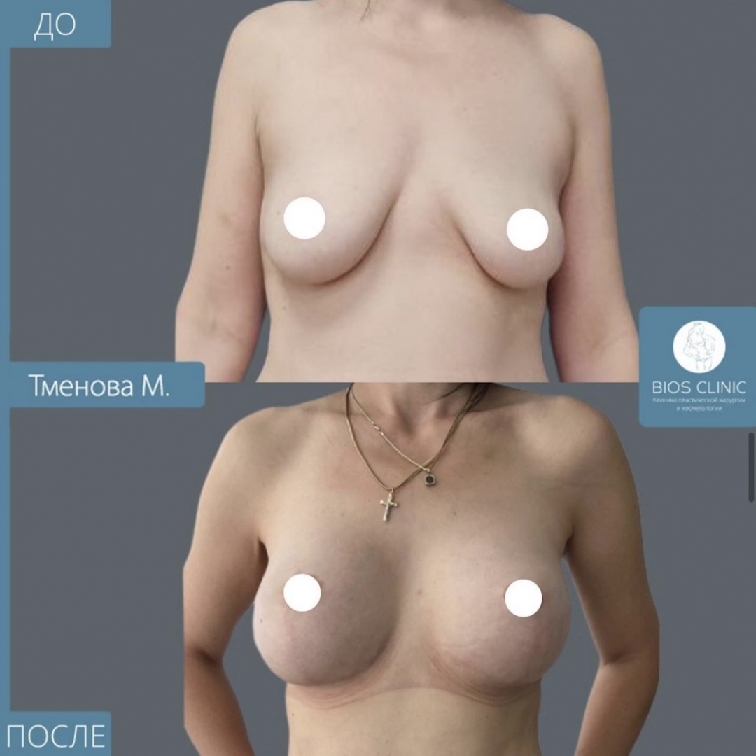 Т образная подтяжка с увеличением груди фотография 2