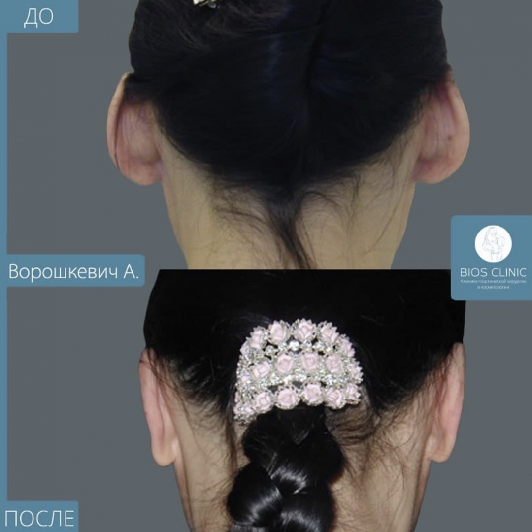 До и после операции отопластика (пластика ушных раковин)