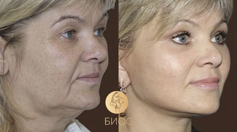 Подтяжка лица и шеи, верхняя и нижняя блефаропластика Ворошкевич А.А.