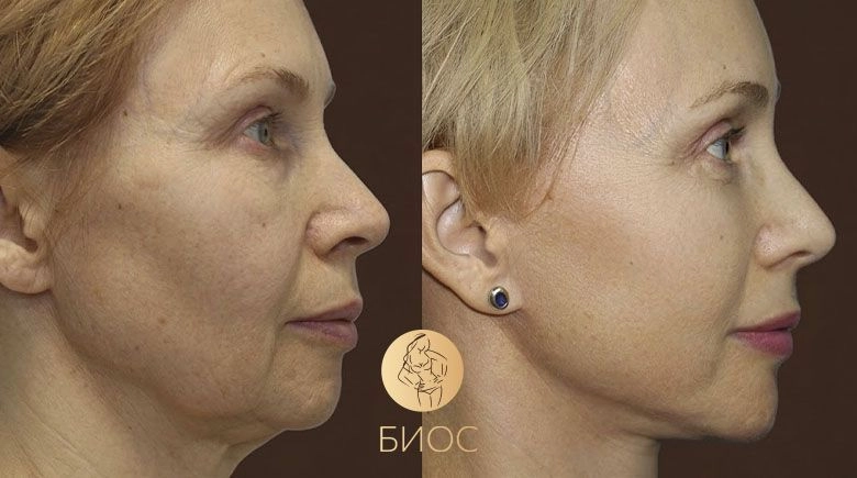 Фейслифтинг со Смас подтяжкой и нижняя блефаропластика Ворошкевич А.А.