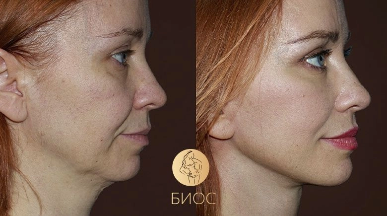 Фейслифтинг Ворошкевич А.А.