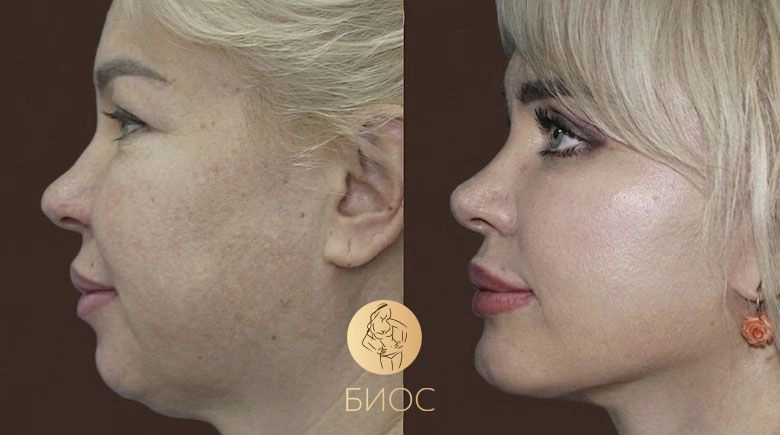 Комплексное омоложение: фейслифтинг, блефаропластика, ментопластика Ворошкевич А.А.