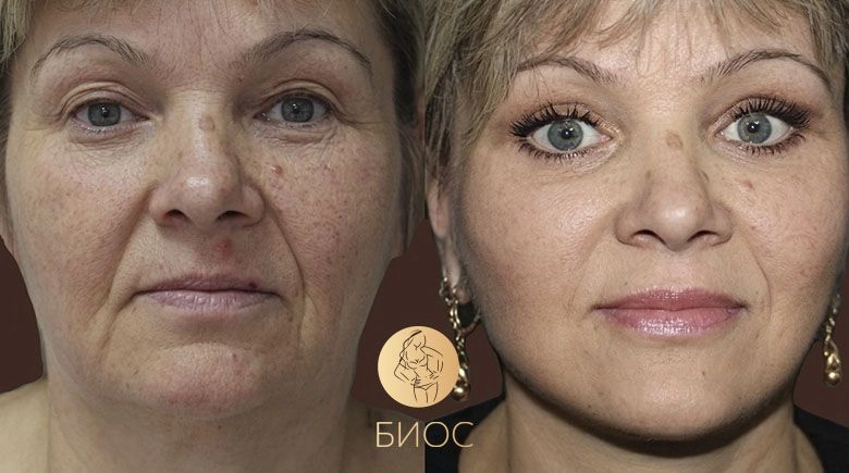 Подтяжка лица и шеи, верхняя и нижняя блефаропластика Ворошкевич А.А.