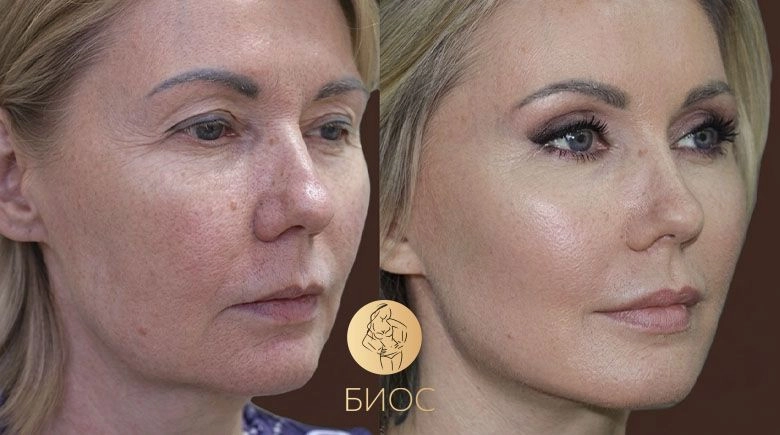 Фейслифтинг, верхняя и нижняя блефаропластика Ворошкевич А.А.