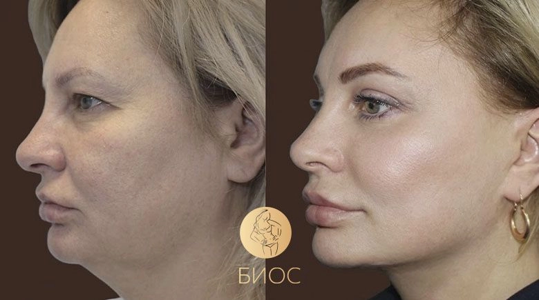 Пластика лица со смас подтяжкой, блефаропластика Ворошкевич А.А.