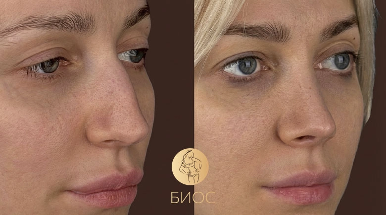 Ринопластика при искривлении носа Трубицын Р.В.