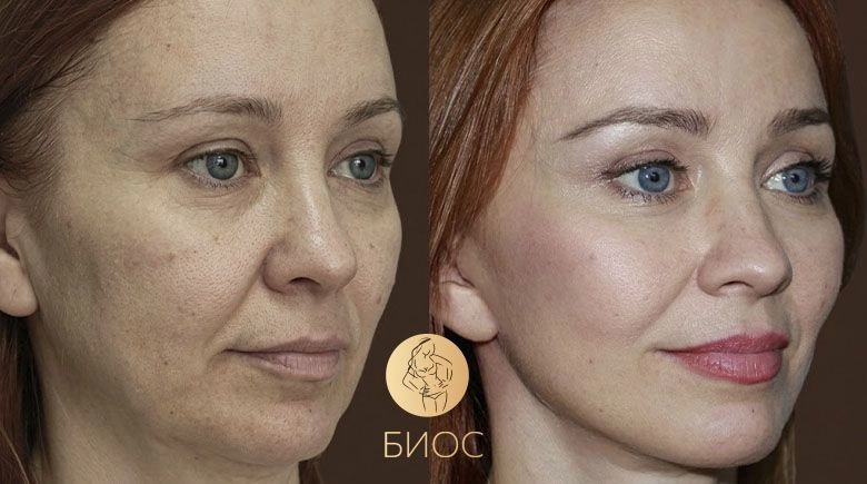 Фейслифтинг Ворошкевич А.А.