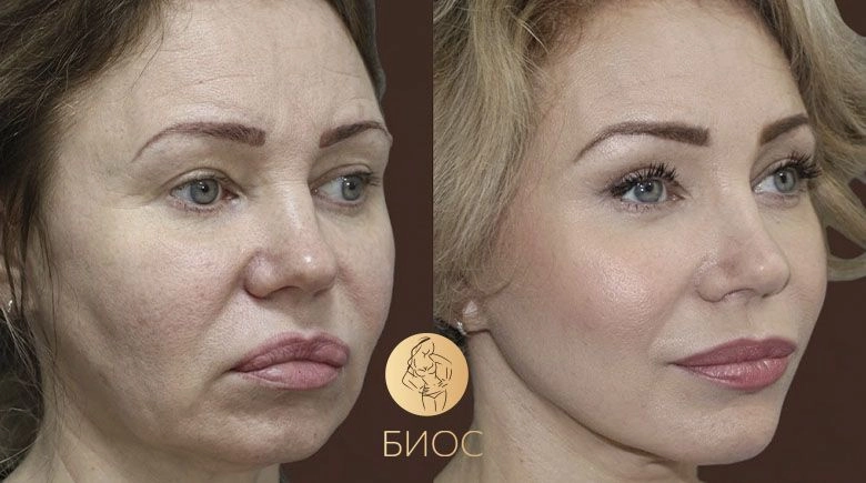 Фейслифтинг со СМАС подтяжкой лица и шеи, удаление биополимера Ворошкевич А.А.