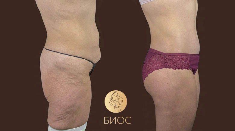 Бодилифтинг и феморопластика (подтяжка бёдер) после массивной потери веса Тменова М.В.