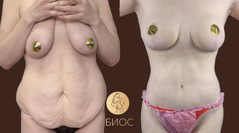 подтяжка тела после похудения