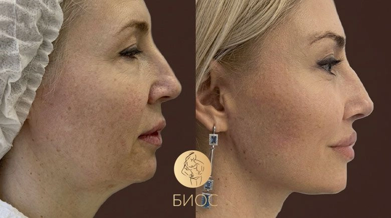 Фейслифтинг, Круговая блефаропластика, височный лифтинг Тменова М.В.