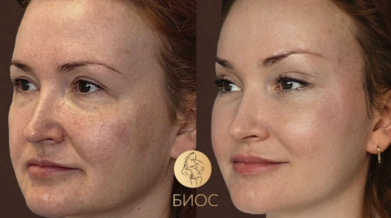 Эндоскопическая подтяжка верхней трети лица Трубицын Р.В.