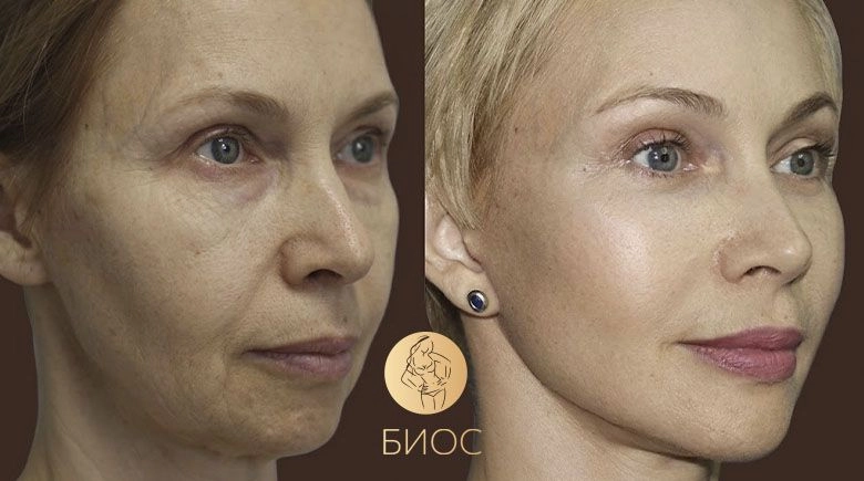 Фейслифтинг со Смас подтяжкой и нижняя блефаропластика Ворошкевич А.А.