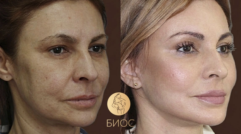 Фейслифтинг со СМАС подтяжкой и эндоскопический лифтинг лобно-височный Ворошкевич А.А.
