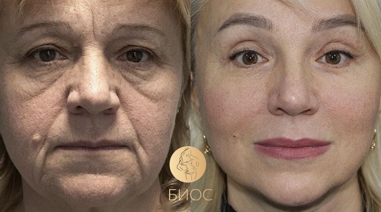 комплексное омоложение