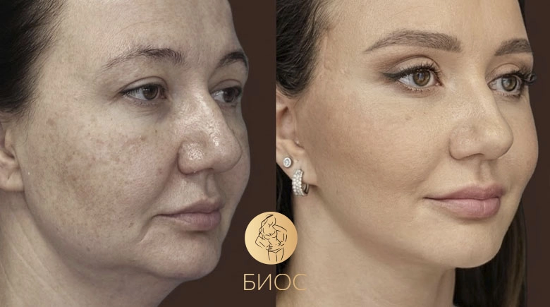 Смас подтяжка лица и шеи, круговая блефаропластика Ворошкевич А.А.
