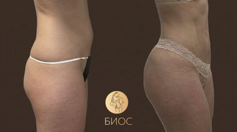 Липомоделирование с липофилингом ягодиц Тменова М.В.