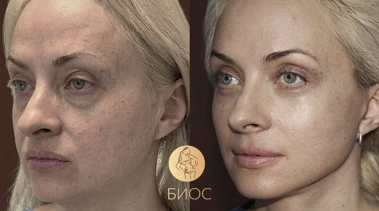Комплексное омоложение Ворошкевич А.А.