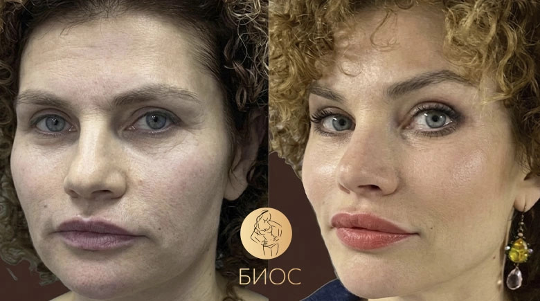 эндоскопическая подтяжка