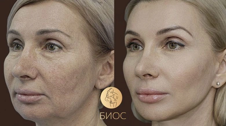Фейслифтинг СМАС, нижняя блефаропластика Ворошкевич А.А.