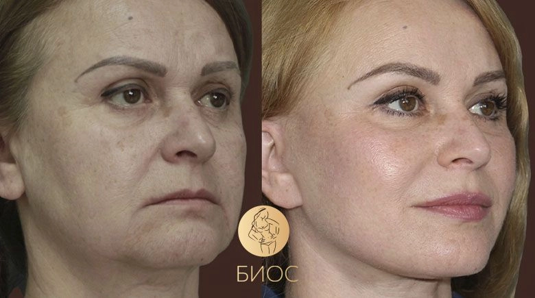 Подтяжка лица и шеи со СМАС подтяжкой Ворошкевич А.А.