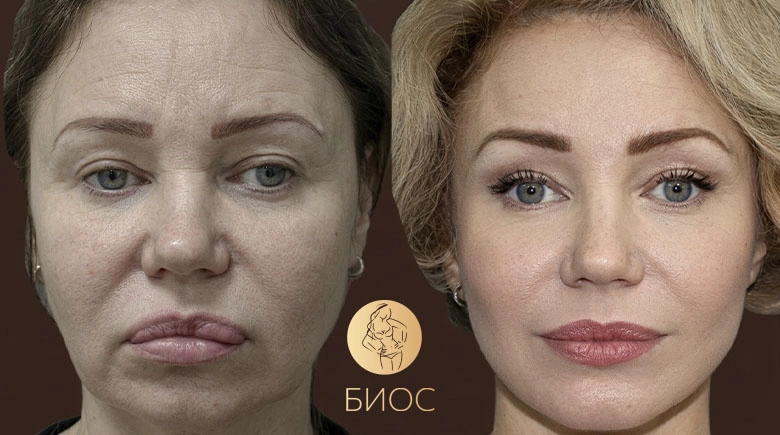 фейслифтинг SMAS