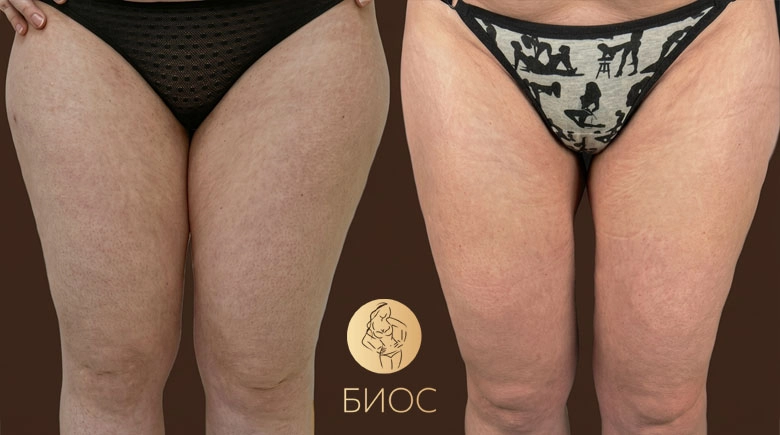 Липосакция бедер Тменова М.В.