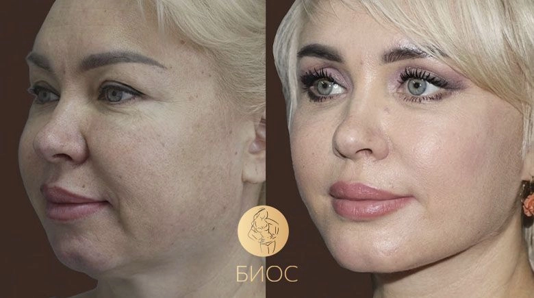 фейслифтинг, блефаропластика, ментопластика
