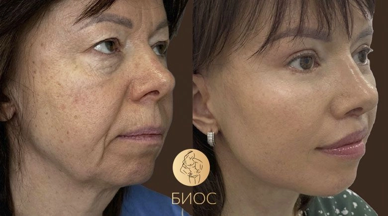Фейслифтинг, круговая блефаропластика Тменова М.В.