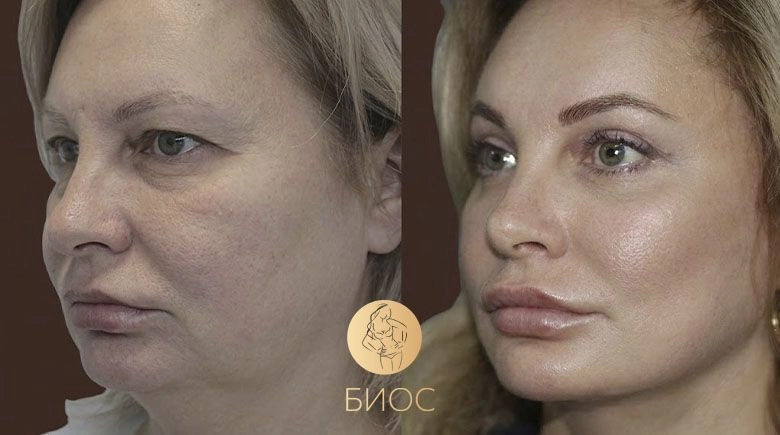 Пластика лица со смас подтяжкой, блефаропластика Ворошкевич А.А.