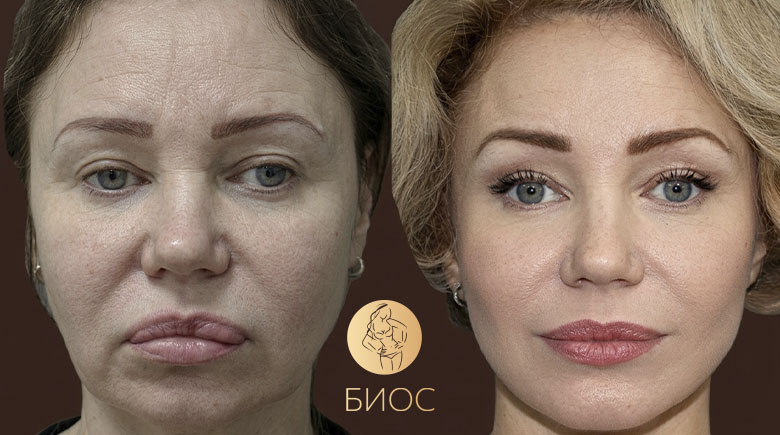 фейслифтинг SMAS